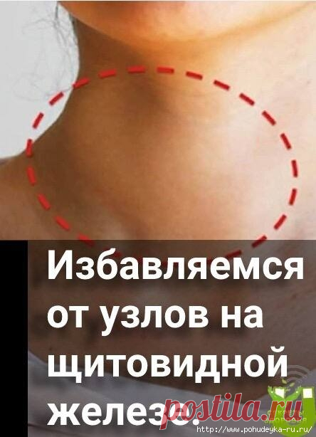 Как избавиться от узлов на щитовидной железе домашними средствами