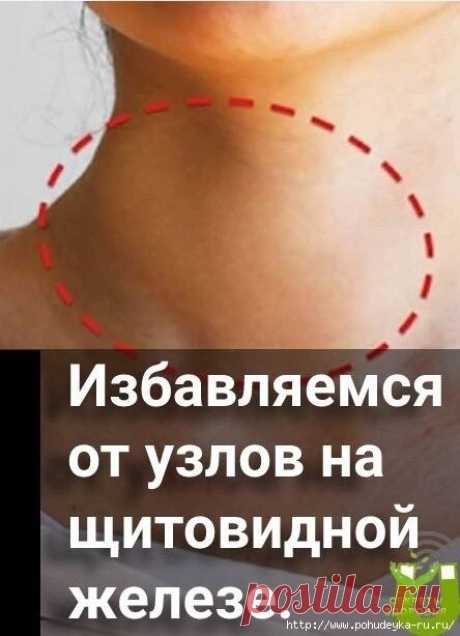 Как избавиться от узлов на щитовидной железе домашними средствами