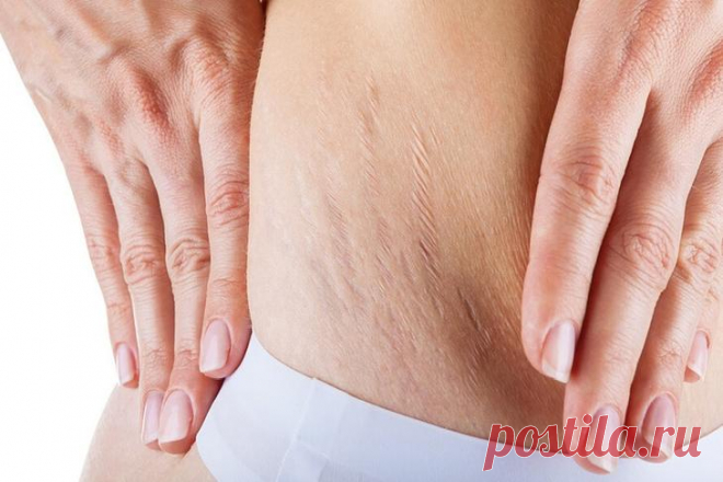 6 натуральных средств, которые помогут сделать растяжки незаметными