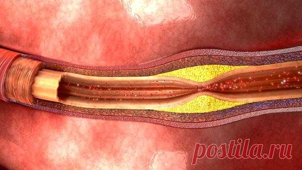 Старение сосудов: что ускоряет этот процесс, чем он опасен и как его замедлить Из-за каких привычек наши сосуды стареют ускоренно? Как сохранить здоровье сосудов? Fotodom.ru«Сосуды стареют вместе с организмом, и возраст — практически непреодолимый фактор. У некоторых людей старение сосудов развивается ускоренно, а у других этот процесс происходит медленнее, чем у среднего...