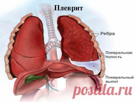 Осумкованный плеврит легких: симптомы и лечение