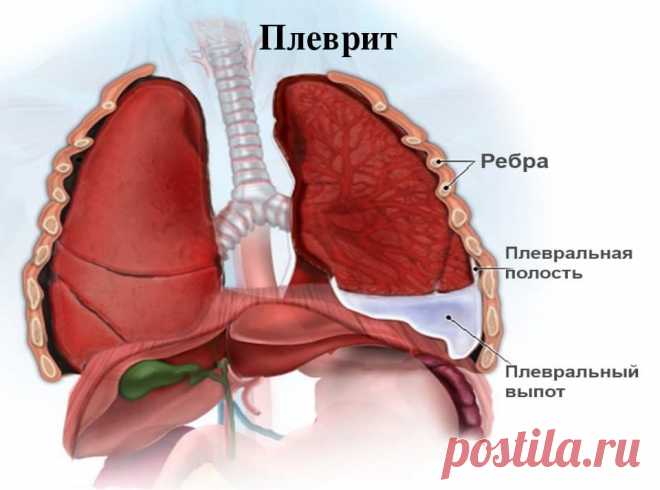 Осумкованный плеврит легких: симптомы и лечение