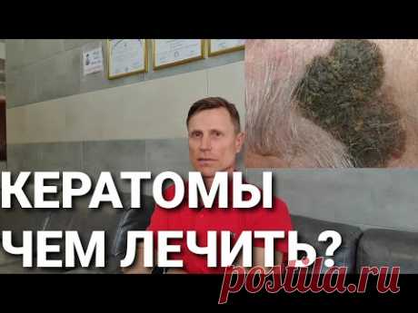 Кератомы. Чем лечить?