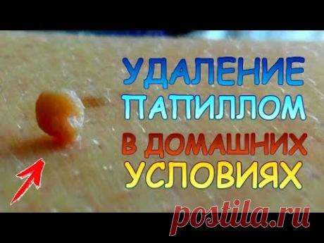Как лечить вирус папилломы человека? Удаление папиллом, кондилом, бородавок в домашних условиях.