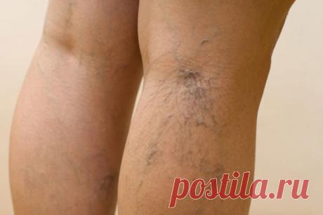 Как я избавилась от сосудистых звездочек за 2 недели