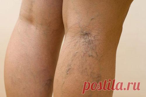 Как я избавилась от сосудистых звездочек за 2 недели
