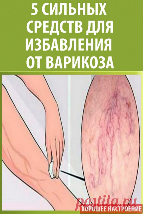 5 сильных средств для избавления от варикоза