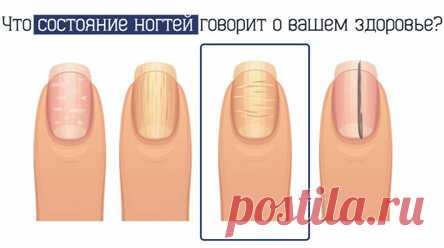 Выпуклости на ногтях: на какие болезни указывают данные симптомы? Мы редко обращаем внимание на здоровье своих ногтей. Вернее, зачастую считаем, что это лишь косметическая проблема. Но на самом деле состояние ваших ногтей может многое поведать о том, что же происходит с вашим здоровьем. К примеру, горизонтальные выпуклости – это признак псориаза. Журнал Ещё! хочет рассказать вам о других важных симптомах, которые указывают на те или иные заболевания. Что состояние ногтей р...
