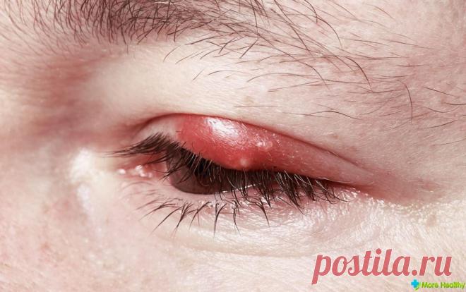 Народные средства от ячменя на глазу