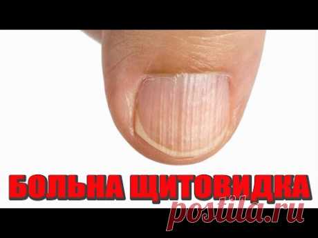 Ваша Щитовидка бьет тревогу! Острые признаки Заболевания щитовидной железы