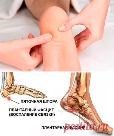 Лечение пяточной шпоры в домашних условиях народными средствами - профилактика