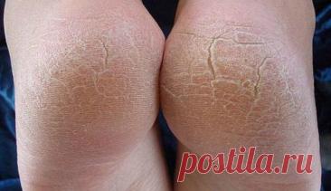 Вот способ сделать пятки мягкими, как кошкины лапки: сухость и трещины остались в прошлом! — Домашний уют