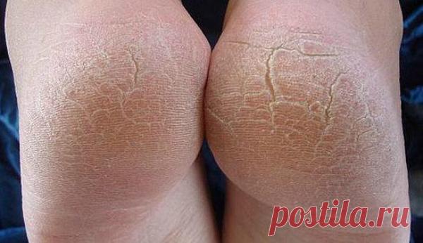 Вот способ сделать пятки мягкими, как кошкины лапки: сухость и трещины остались в прошлом! — Домашний уют