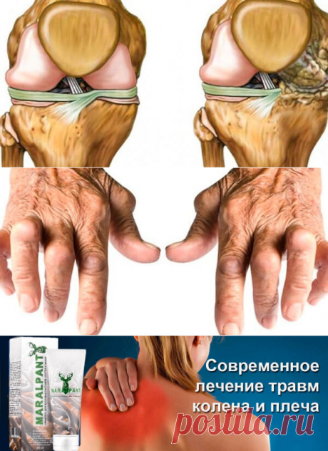 MaralPant крем для суставов
Для начала давайте разберем 9 главных причин появления болезней суставов:
Инфекции
Воспаления
Неправильное питание
Вредные привычки
Лишний вес
Травмы
Высокие нагрузки
Сидячая работа
Возраст 35+