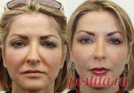 Даже очень дряблая кожа лица после этой процедуры подтянется! Делайте это 1 раз в неделю - Идеи на любой случай
