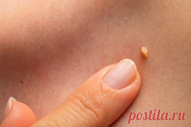 10 простых способов избавления от папиллом в домашних условиях: что-то вам точно поможет - Домашний Уют