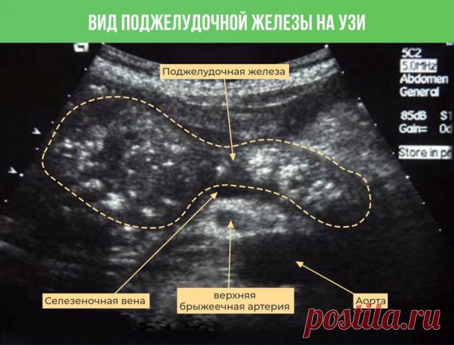 Лечение воспаления поджелудочной железы в домашних условиях (амбулаторно), место средств народной медицины.