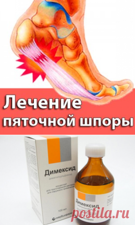 Пяточная шпора причины, симптомы и лечение в домашних условиях