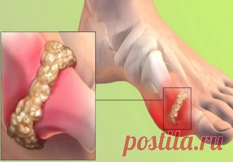 Что можно и чего нельзя есть при подагре / Будьте здоровы