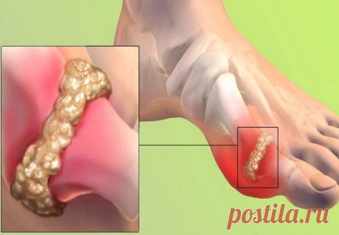 Что можно и чего нельзя есть при подагре / Будьте здоровы