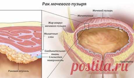 Виды онкологических заболеваний