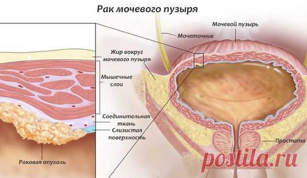 Виды онкологических заболеваний