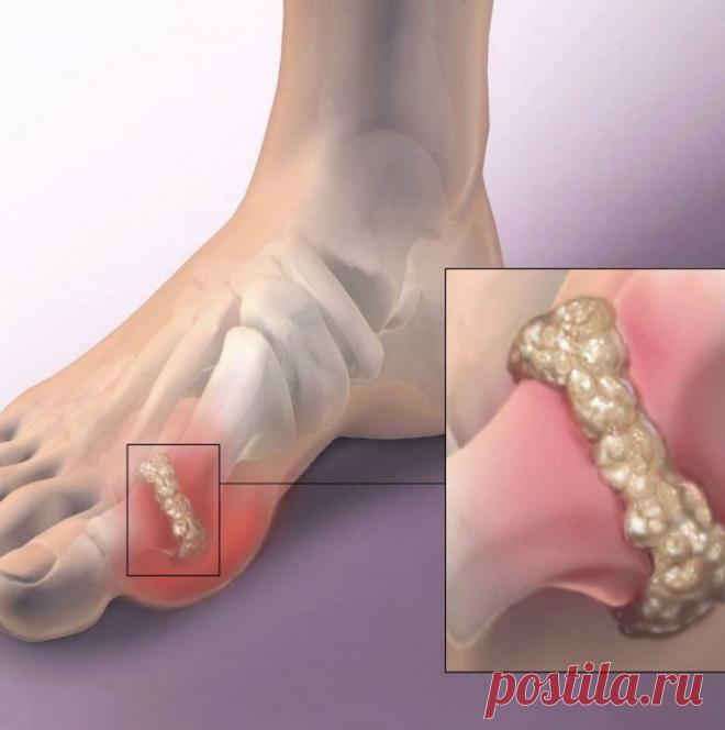 Овощи, которые помогут снизить показатель мочевой кислоты в организме / Будьте здоровы
