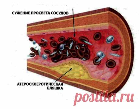 Бляшки в кровеносных сосудах...

Достаточно большое число людей ошибочно полагают что образование бляшек в кровеносных сосудах происходит только в пожилом возрасте, но это полностью не соответствует действительности. Наиболее ранние пласты образующиеся в артериях из бляшек и тромбов могут появиться и в 20 лет.
