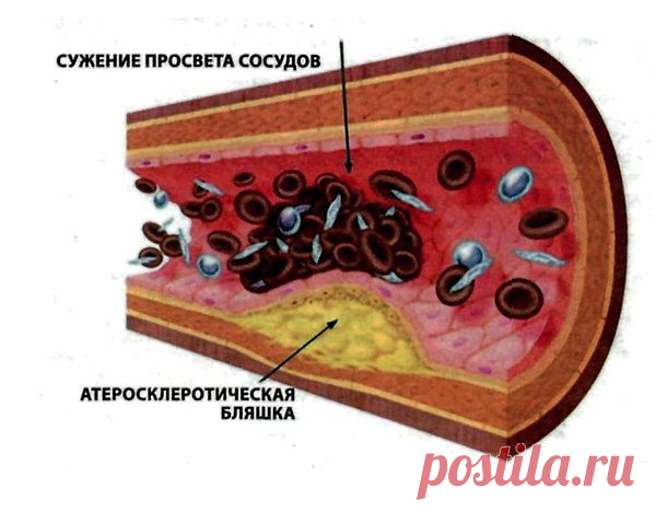 Бляшки в кровеносных сосудах...

Достаточно большое число людей ошибочно полагают что образование бляшек в кровеносных сосудах происходит только в пожилом возрасте, но это полностью не соответствует действительности. Наиболее ранние пласты образующиеся в артериях из бляшек и тромбов могут появиться и в 20 лет.