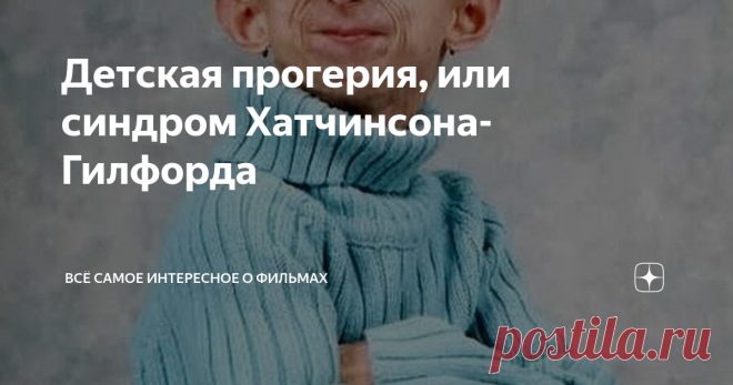 Детская прогерия, или синдром Хатчинсона-Гилфорда Детская прогерия, или синдром Хатчинсона-Гилфорда, — заболевание, которым страдает один человек из пяти миллионов. Организм детей с таким диагнозом стареет чрезвычайно быстро и рано: уже в подростковом возрасте пациенты выглядят и чувствуют себя, как старики. У них развивается множество старческих патологий, возникают нарушения в работе внутренних органов и систем, а кости, кожа, мышцы и