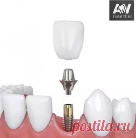 Имплантация зубов в Самаре от 30000 рублей, AV Dental Clinic