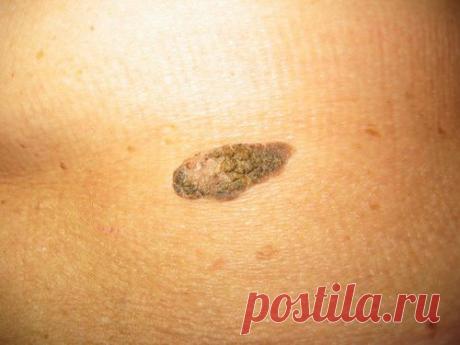 Кератома: причины возникновения,виды, методы лечения