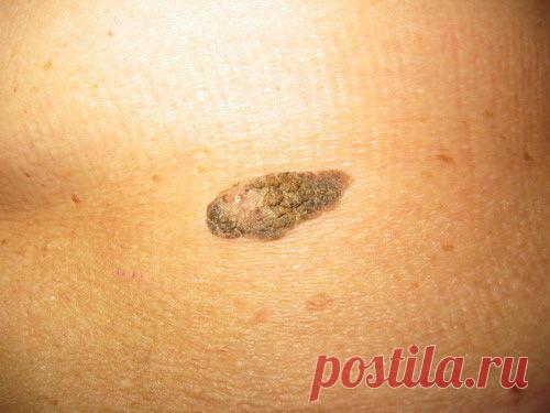 Кератома: причины возникновения,виды, методы лечения