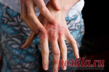 Псориаз: причины возникновения и симптомы, лечение болезни