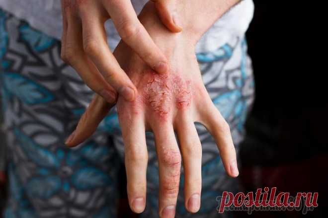 Псориаз: причины возникновения и симптомы, лечение болезни