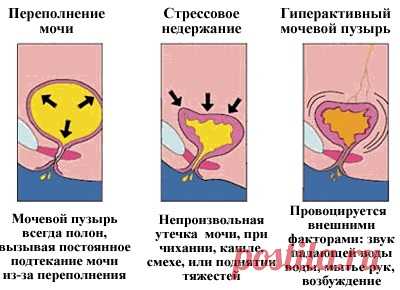 Недержание мочи опасно. Как вылечить эту патологию дома?