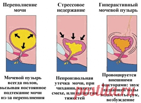 Недержание мочи опасно. Как вылечить эту патологию дома?