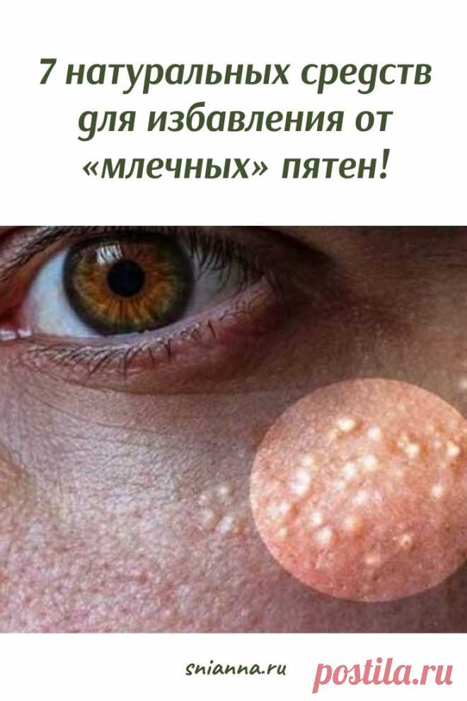 Млечные пятна - 7 натуральных средств для избавления. Млечные пятна на лице. Как от них избавиться? ➡️ Кликайте на фото, чтобы прочитать статью полностью