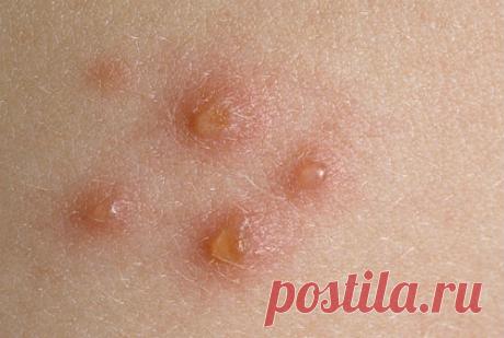 Как выглядит псориаз на начальной стадии, фото, симптомы