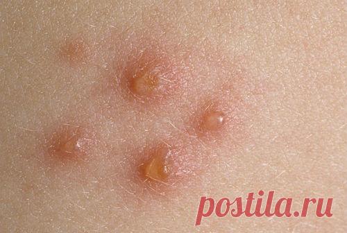 Как выглядит псориаз на начальной стадии, фото, симптомы