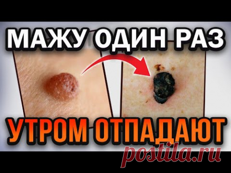 Запомни! Врачи Только Так растворяют бородавки и папилломы домашними средствами, а именно...