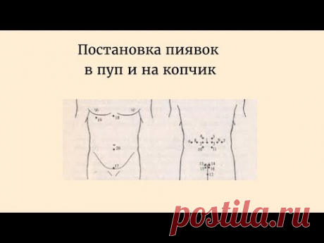 Постановка пиявок в пуп и на копчик