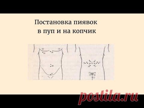 Постановка пиявок в пуп и на копчик