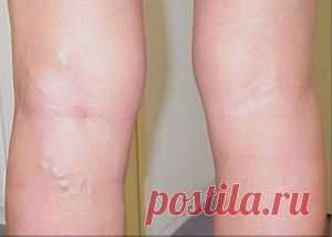 Тромбофлебит нижних конечностей: симптомы и народное лечение