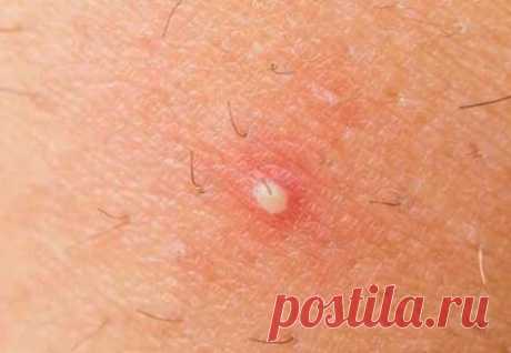 Вот, как вы можете исцелить заблокированные потовые железы