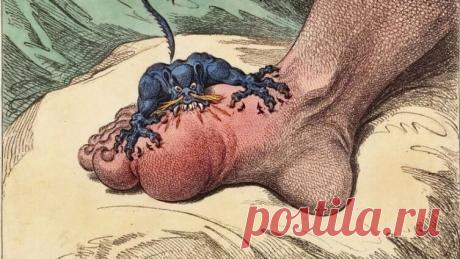 Подагра в культуре и в анамнезе: как избежать болезни королей? | Красота и здоровье