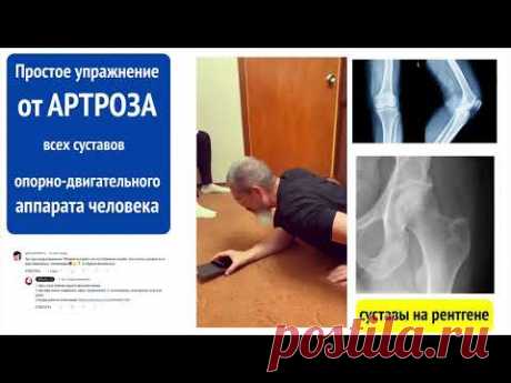 Артроз, который "не лечится", сразу начнёт лечиться, если ляжешь на живот и сделаешь это  👍