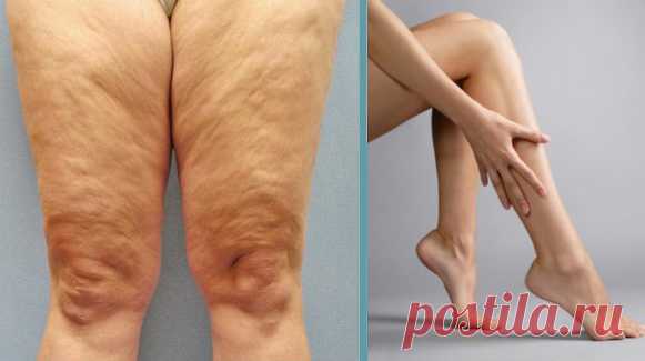 Как избавиться от целлюлита в домашних условиях? - Журнал Советов Девочки, весь жир с ног можно убрать в любое время года и в любом возрасте! Потрясающе простой рецепт за короткое время убрал все мои недостатки! Как? Да очень просто! Как убрать лишний жир со своих ножек? Так уж повелось, что ноги являются олицетворением женской красоты. И это не банально, ведь часто приходится слышать крылатые фразы, […]