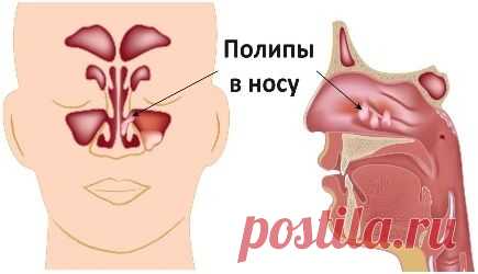 Способы лечения полипов в носу