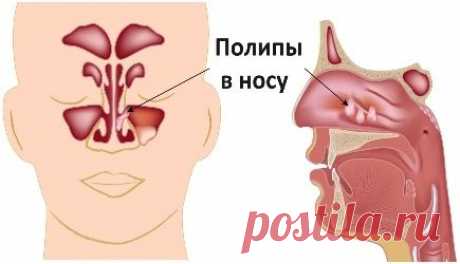 Способы лечения полипов в носу